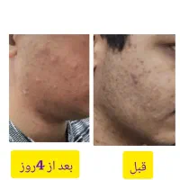 سرم ضد جوش|آرایشی، بهداشتی، درمانی|تهران, آبشار تهران (دریاچه)|دیوار