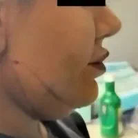 ساکشن غبغب عمل عمل بینی فقط ۳۰ تومن