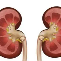 درمان گیاهی سنگ کلیه با نظارت متخصص