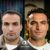 کاشت مو در بهترین کلینیک مشهد