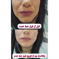 بوتاکس ژل فیلر فیلربادی مزوتراپی پی آر پی در مطب|خدمات آرایشگری و زیبایی|زنجان, |دیوار