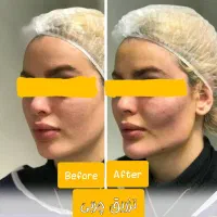 تخفیف ژل و بوتاکس و مزوتراپی و تزریق چربی|خدمات آرایشگری و زیبایی|صدرا-فارس, فاز ۱|دیوار