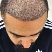 کاشت مو و ابرو با جدید ترین دستگاه های روز دنیا|خدمات آرایشگری و زیبایی|یاسوج, |دیوار