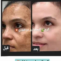 کرم ضدلک و روشن کننده درخشان(بدون بازگشت)|آرایشی، بهداشتی، درمانی|شیراز, قصرالدشت|دیوار