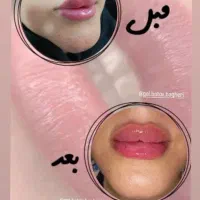 تزریق ژل و بوتاکس|خدمات آرایشگری و زیبایی|قم, مهدیه|دیوار