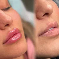 ژل لب گونه چانه،فول فیس لیفت نخ/لیزرآنزیم بوتاکس|خدمات آرایشگری و زیبایی|مشهد, هفت تیر (آب و برق)|دیوار
