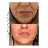 انجام تمامی خدمات فیلر و بوتاکس|خدمات آرایشگری و زیبایی|سبزوار, توحیدشهر|دیوار