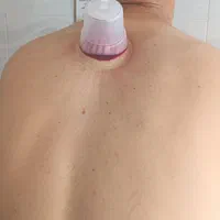 حجامت تزریقات زالو دیسک خال و زگیل تناسلی میگرن