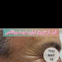 بوتاکس طبیعی|خدمات آرایشگری و زیبایی|رشت, منظریه|دیوار
