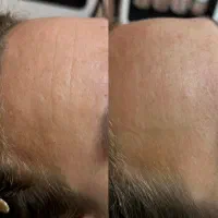 تخفیف لیزر ژل بوتاکس هایفو|خدمات آرایشگری و زیبایی|تهران, جیحون|دیوار