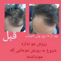 انواع مشکلات ریزش مو و راهکار آن