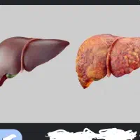 کبدسالم‌یاکبدگرید
