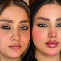 تخفیف خدمات ژل/بوتاکس/جوانساز توسط پزشک|خدمات زیبایی و سلامت|اهواز, زیتون کارمندی|دیوار