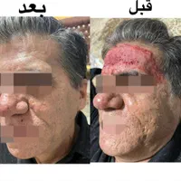 تزریق ژل بوتاکس مزونیدلینگ ، مزوسروابرو ،فیلربادی|خدمات آرایشگری و زیبایی|تهران, نیروی هوایی (پیروزی)|دیوار