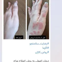 درمان مشکلات بدنی وپوستی واگزما