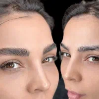 میکروبلیدینگ و فیبروز ابرو با تخفیف ویژه
