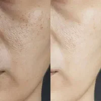 پاکسازی و جوانسازی پوست با تجهیزات پیشرفته|خدمات آرایشگری و زیبایی|رشت, گلسار|دیوار