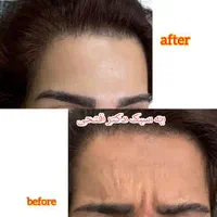 انجام کلیه خدمات زیبایی توسط پزشک در کلینیک در فسا|خدمات آرایشگری و زیبایی|فسا, |دیوار