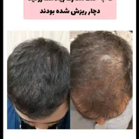 درمان ریزش و رویش مجدد مو|آرایشی، بهداشتی، درمانی|لاهیجان, بازکیاگوراب|دیوار