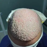 جشنواره پاییزی کاشت مو