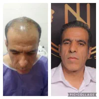 کاشت مو و ابرو با ضمانتنامه کتبی با ۸ ملیون تومان|خدمات آرایشگری و زیبایی|تهران, پاسداران|دیوار