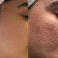 پی‌ارپیprpدومرحله‌ای‌/اگزوزوم‌تراپی‌‌/فیوژن‌/خال|خدمات زیبایی و سلامت|شیراز, زرگری|دیوار