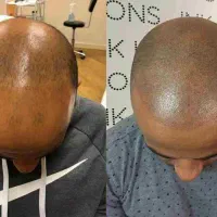 به یک مدل برای میکرواسکالپ کف سر نیازمندیم|خدمات آرایشگری و زیبایی|تهران, جنت‌آباد جنوبی|دیوار