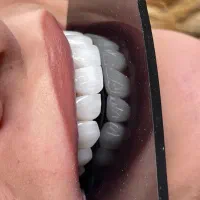 کامپوزیت دندان لمینت دندان