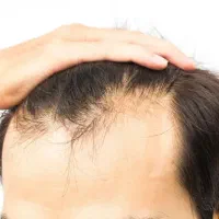 راهنمایی ریزش مو ارثی استرسی ویتامینه جوانساز صورت