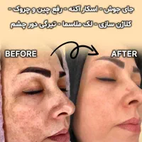 مرکز تخصصی حذف لک وکک ومک|خدمات آرایشگری و زیبایی|اهواز, پادادشهر|دیوار