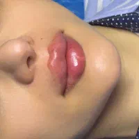 تزریق ژل و بوتاکس