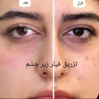 فروش و مدل ژل و بوتاکس|خدمات آرایشگری و زیبایی|اندیکا, |دیوار