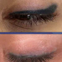 ریموو تتوی بدرنگ و قدیمی در یک جلسه
