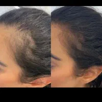 بمب قطعی ریزش مو