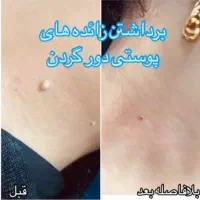 خالبرداری ،رفع کک ومک ... تضمینی