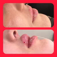 تزریق ژل و بوتاکس و چربی صورت توسط پزشک