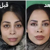 لیپو/ابدو/بلفارو/کاشت/ قسطی در تهران|خدمات آرایشگری و زیبایی|زاهدان, |دیوار