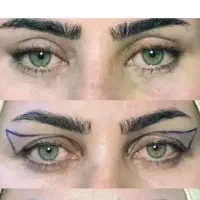متد چشم اروپایی (جایگزین روش قدیمی بلفاروپلاستی)
