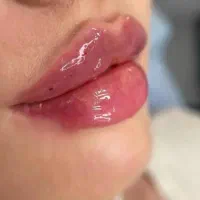 تخفیفات‌ژل بوتاکس‌ مزو فیلرباسن بیکینیprpمو فیبروز