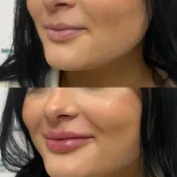 تزریق ژل و بوتاکس جوانسازی