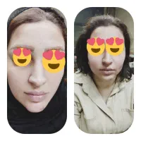 تزریق ژل و بوتاکس|خدمات آرایشگری و زیبایی|کرج, گلشهر|دیوار