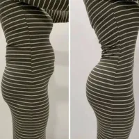 آف50% لیپو ابدو پروتز مامو لیفت سینه لیپوماتیک