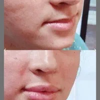تزریق ژل لب.گونه.چانه.زاویه سازی فک.آنزیم بینی|خدمات آرایشگری و زیبایی|اردکان, |دیوار