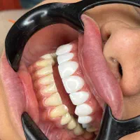کامپوزیت دندان ،لمینت،بلیچینگ (آف بهاری)|خدمات آرایشگری و زیبایی|اصفهان, خانه اصفهان|دیوار