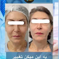 لیزر موهای زائد پی‌آر‌پی هایفو حجم‌سینه‌باسن لاغری|خدمات آرایشگری و زیبایی|تهران, صادقیه|دیوار