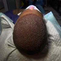 کاشت تخصصی مو سوپرمیکروگرفت با شرایط ویژه