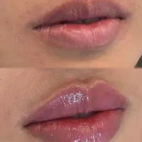 ژل،بوتاکس،مزوتراپی مو صورت،آنزیم،فیلرلب|خدمات آرایشگری و زیبایی|کرج, ساماندهی|دیوار
