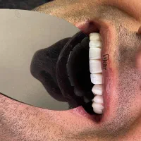 کامپوزیت دندان بیلیچینگ اقساطی|خدمات زیبایی و سلامت|تهران, نارمک جنوبی|دیوار