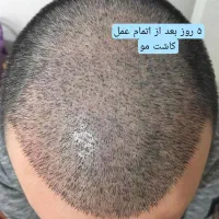 کاشت مو تضمینی