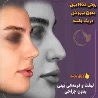 آف رینوپلاستی بینی بدون عمل جراحی Noa پزشک زیبایی